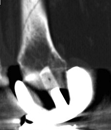 TKR Periprosthetic Fracture Minimall Dislplaced CT